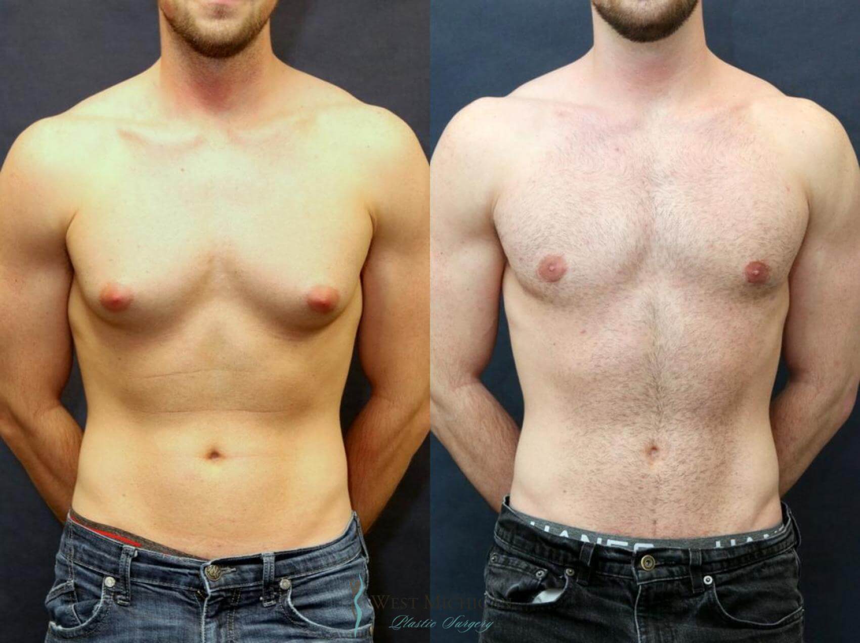 gynecomastia műtét eredménye(1)
