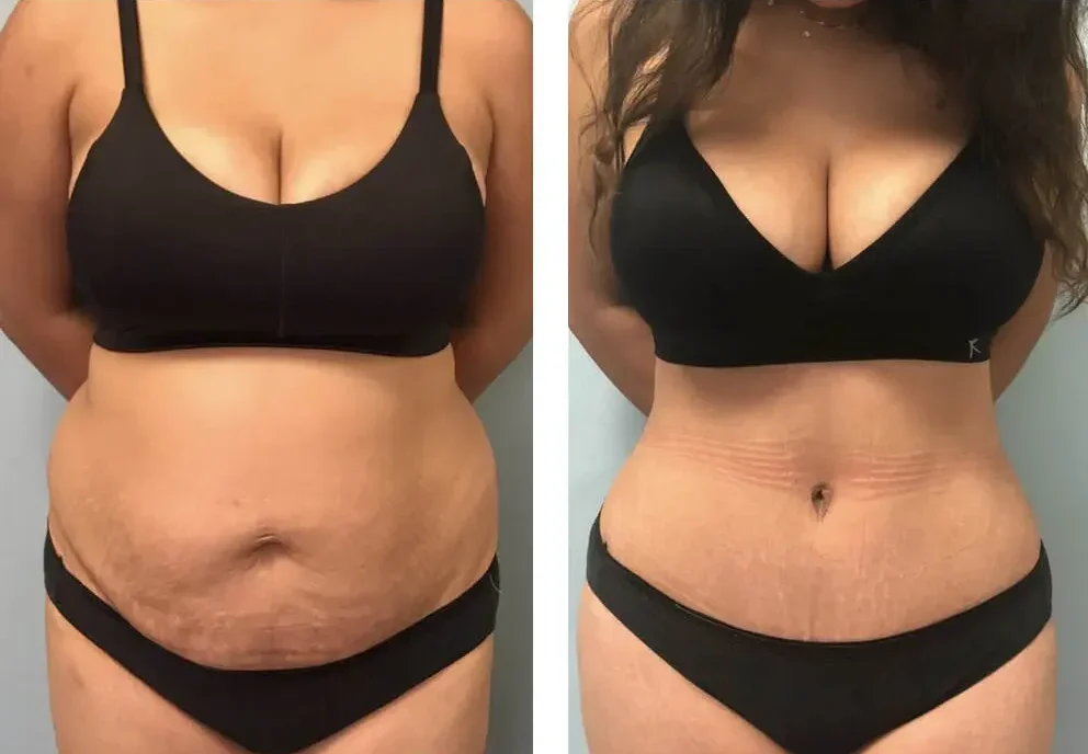 mommy makeover eredménye